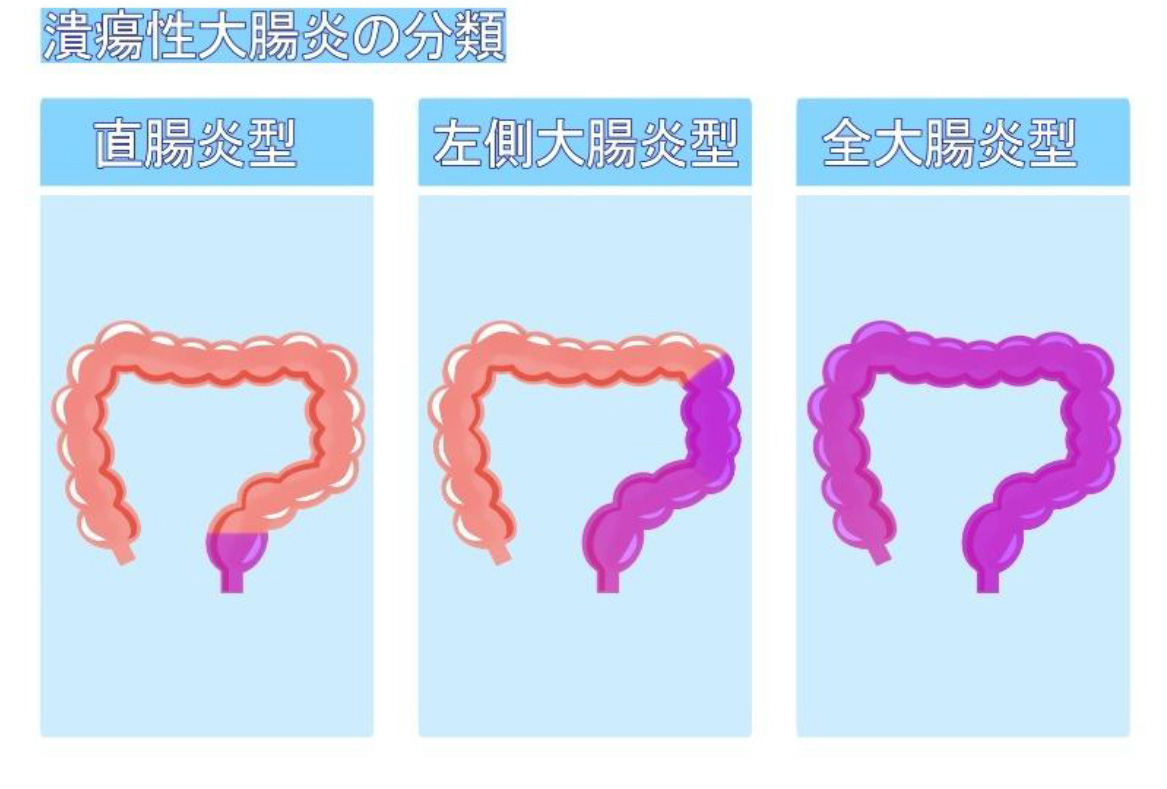 潰瘍性大腸炎の分類 ttl=