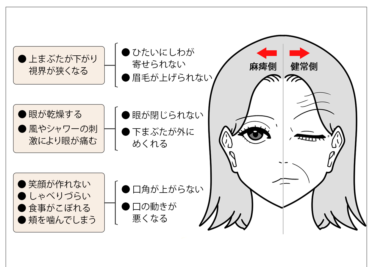 顔面神経麻痺の症状