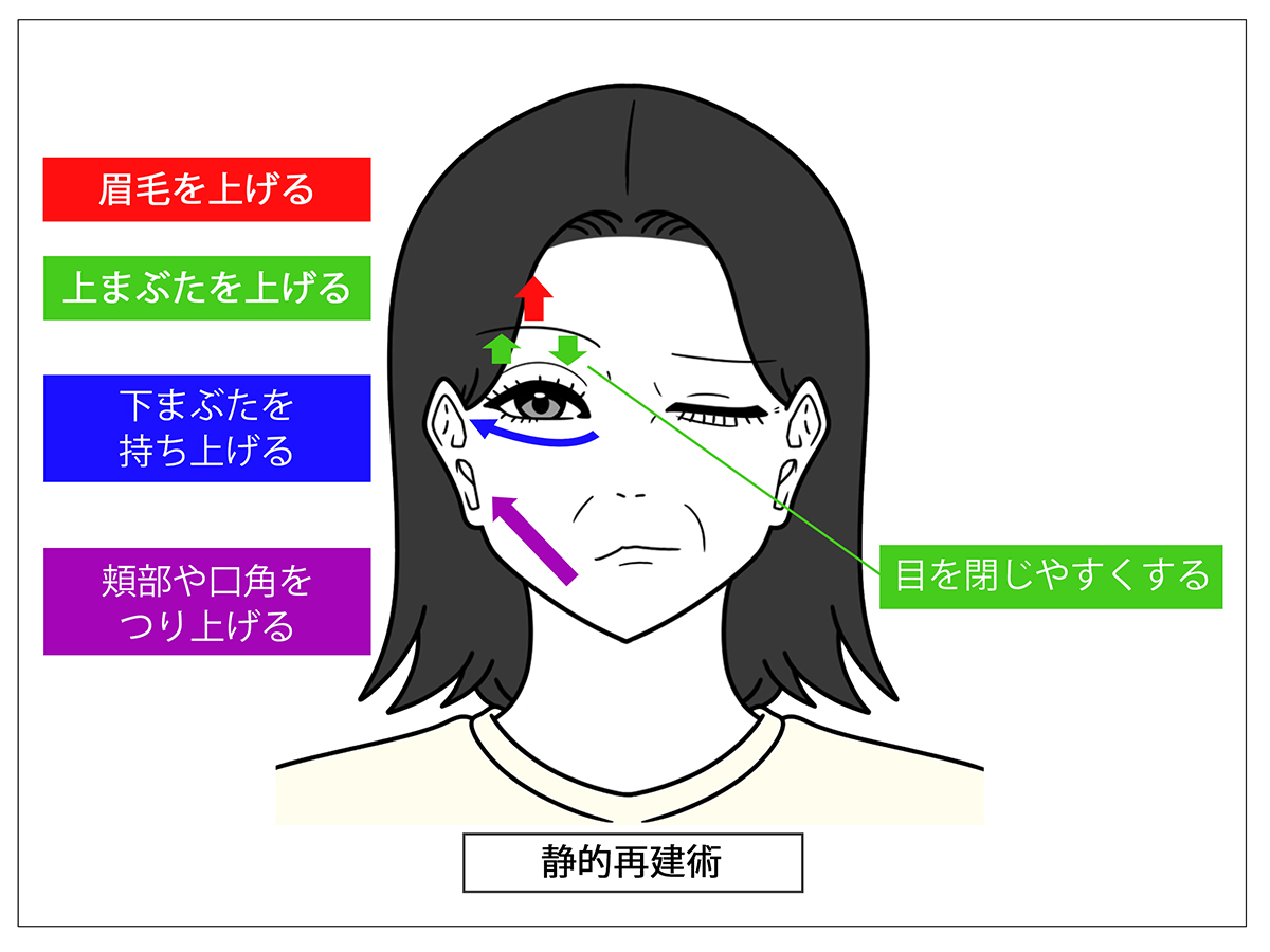 顔に麻痺が残った場合の手術法