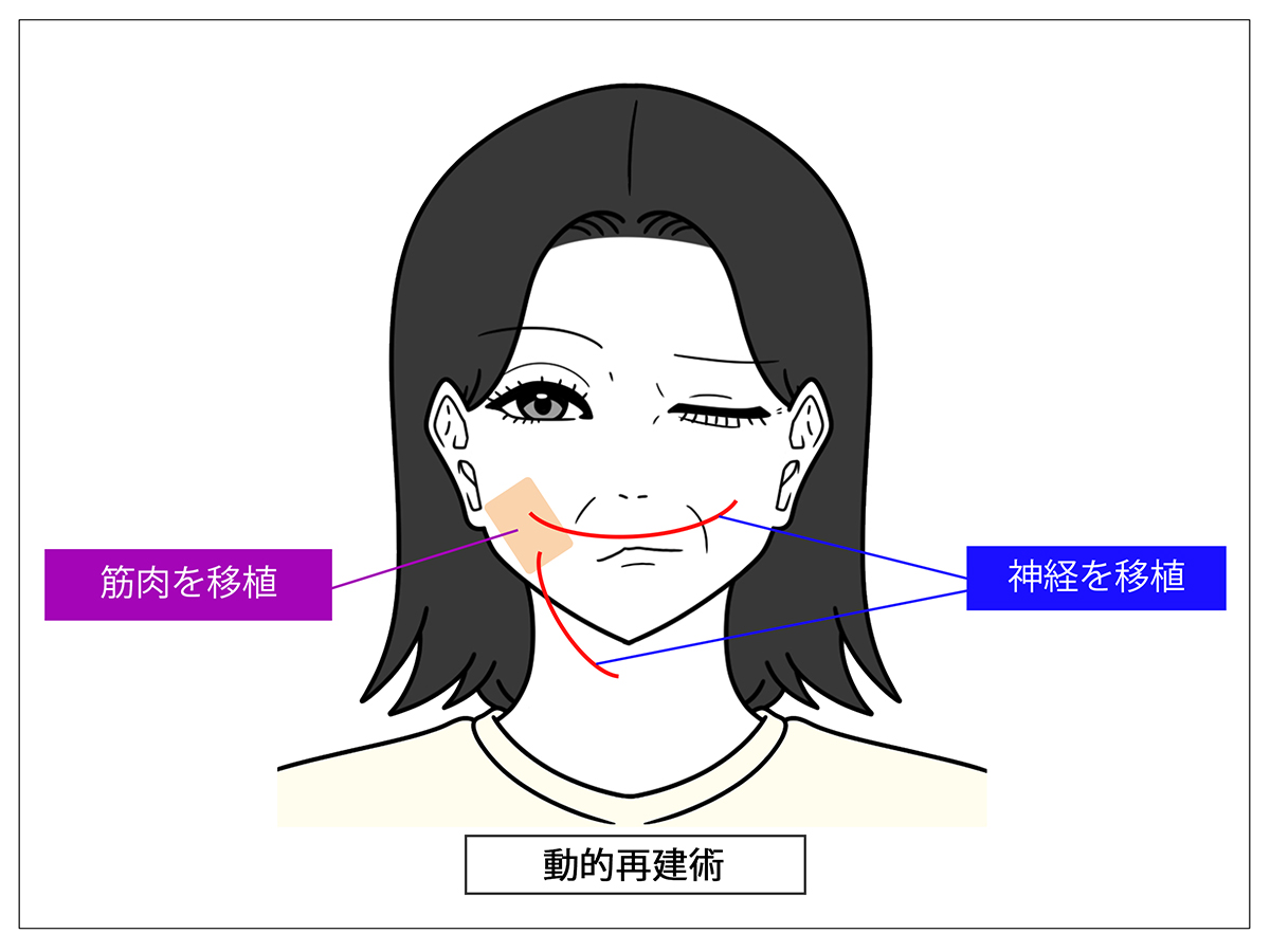 麻痺した部分を動かせるようにする治療